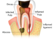 abscess-tooth