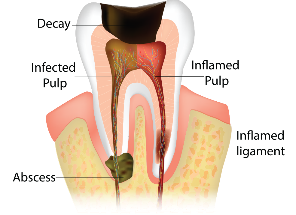 abscess-tooth
